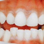 Скученность зубов у взрослых: почему зубы становятся неровными